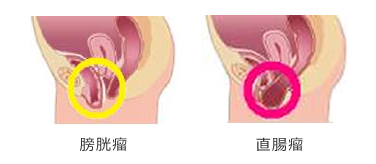膀胱瘤と直腸瘤
